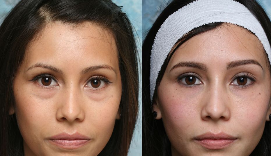 Before &After