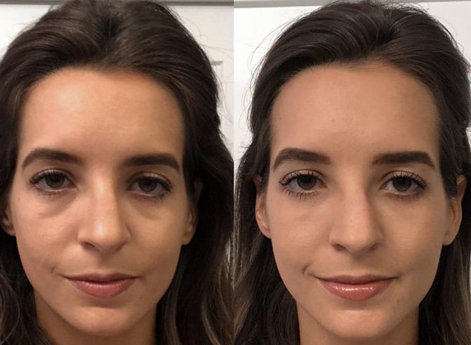Before &After