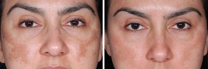 Before &After
