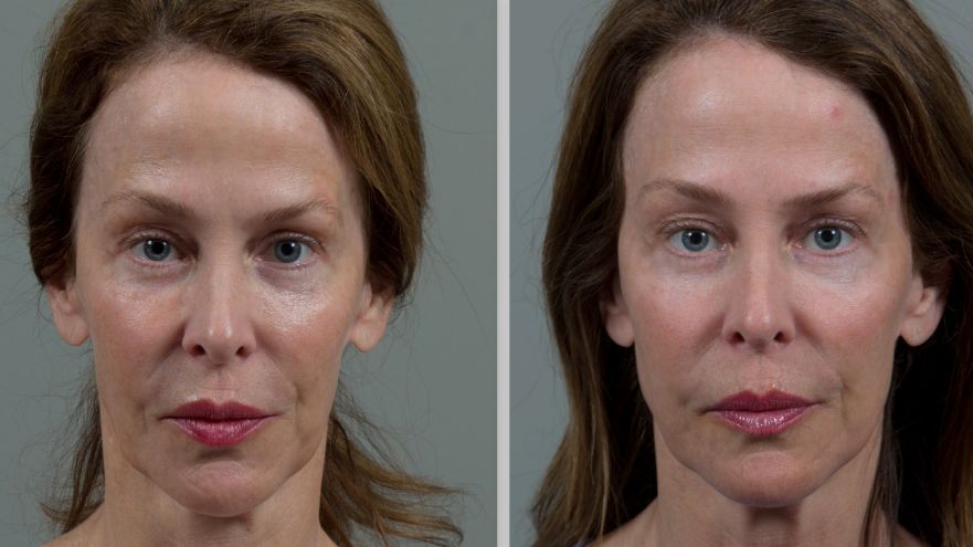 Before &After