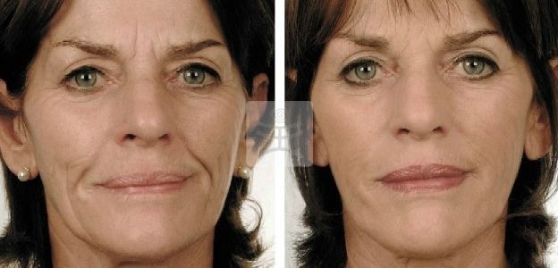 Before & After