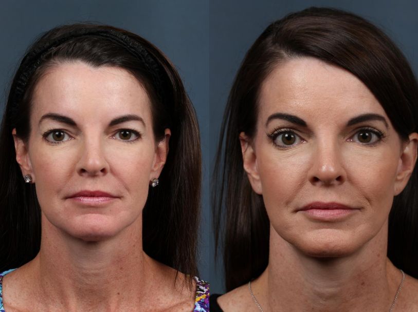 Before &After