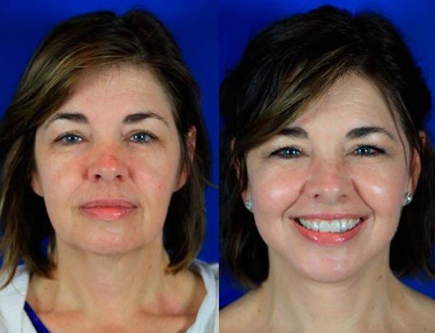 Before &After
