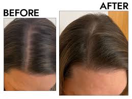Hair Loss in Women