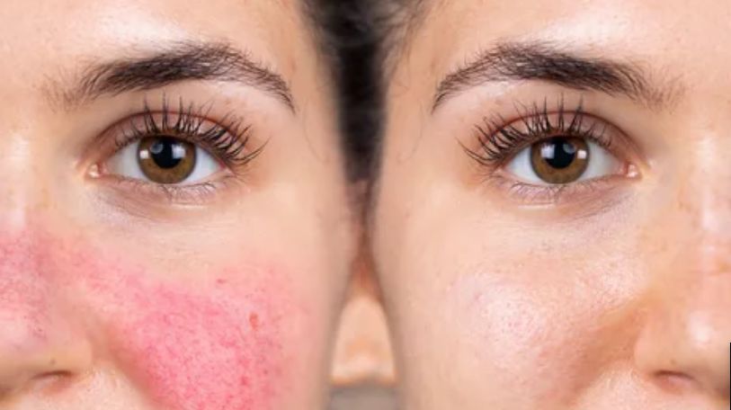 Rosacea treatments