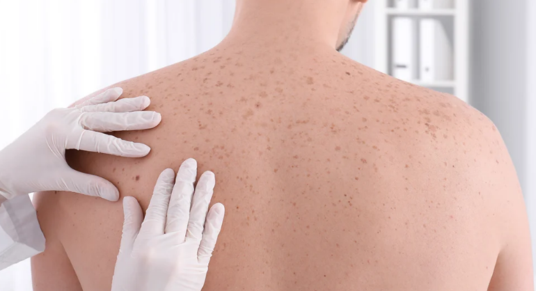 Skin Cancer