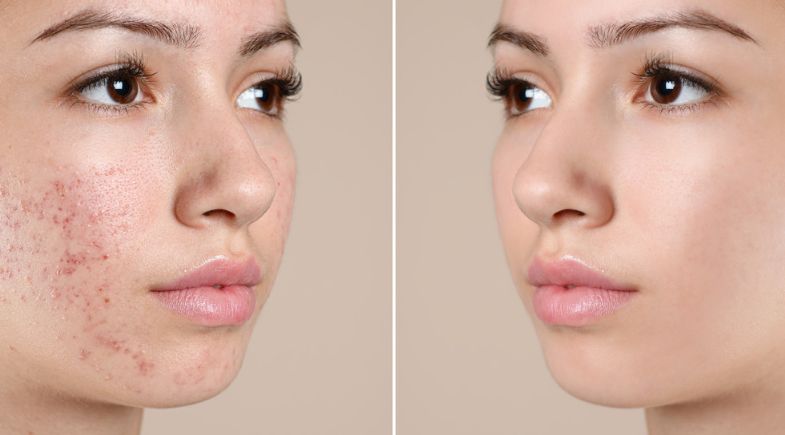 Acne Scar Treatments