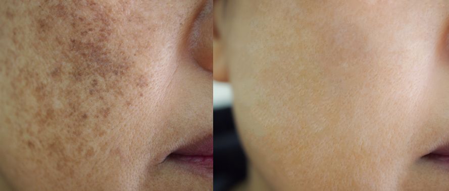 Pigmentation