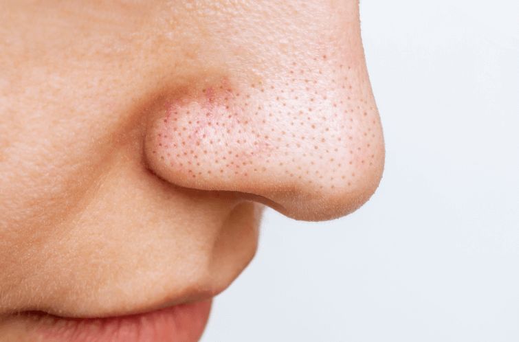 Enlarged Pores