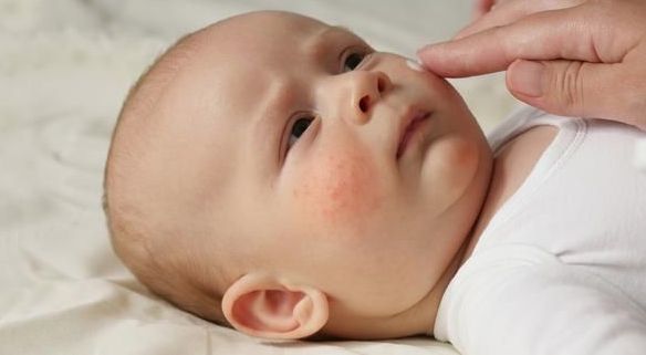 Children's Dermatology