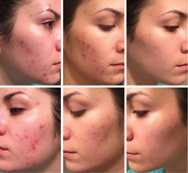 Acne LED Recovery Series