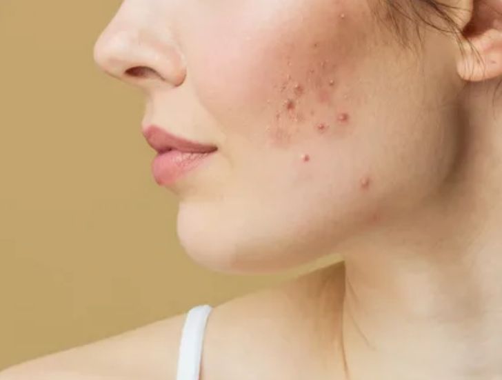 Acne Cyst Treatments