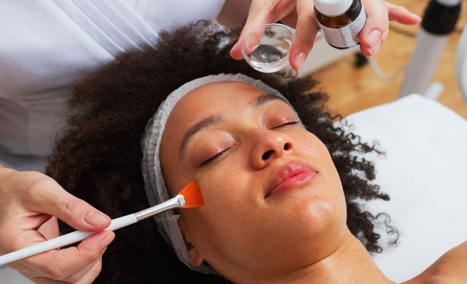 Acne Chemical Peels