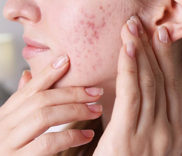 Hormonal Acne Treatments