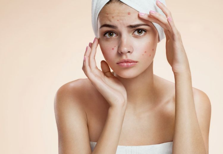 Acne Skin Care