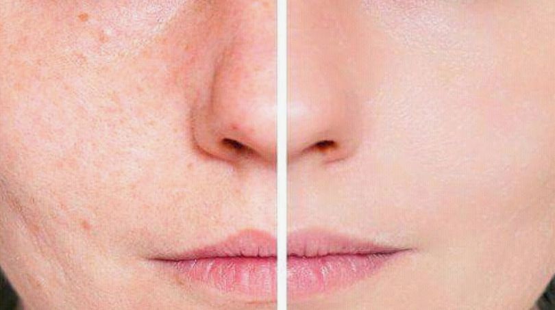 Acne Diet Guide