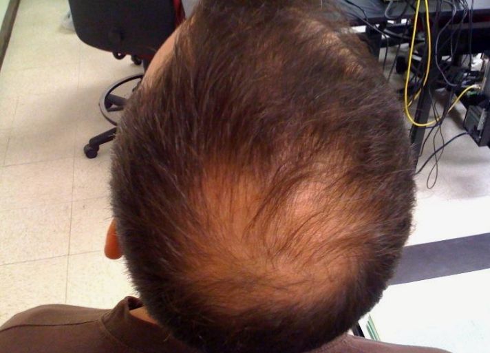 Male Pattern Hair Loss