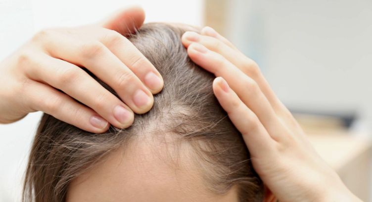 Frontal Fibrosing Alopecia
